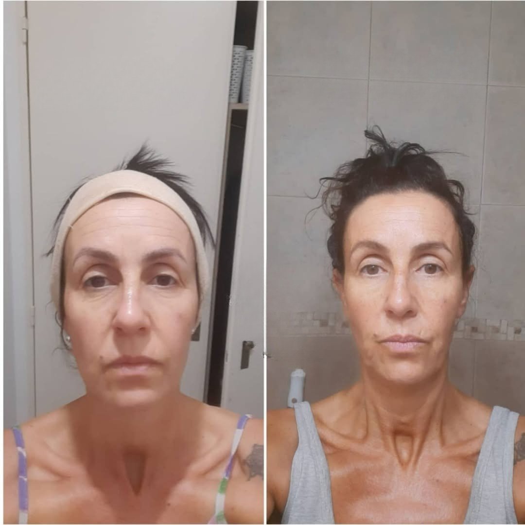 Antes y Después – frente